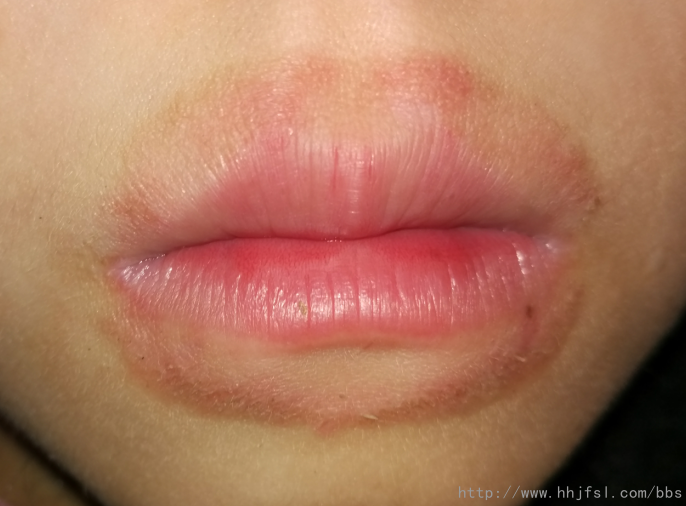嘴唇发红是什么原因?图片