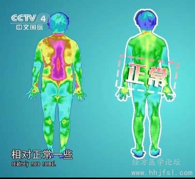 《人体热量分布：红外热成像图》：左侧为肝胃郁热患者.jpg